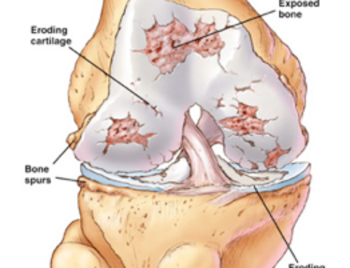 PRP Therapy for Knee Arthritis in Beverly Hills and Los Angeles