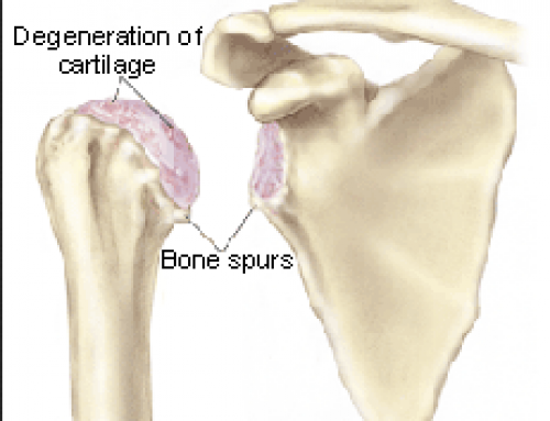 Study Reviews Outcome and Safety of Total Shoulder Replacement