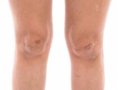 Scar Tissue Impacts After Surgery – Info from a Beverly Hills Orthopedic